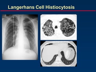 Langerhans Cell Histiocytosis
 