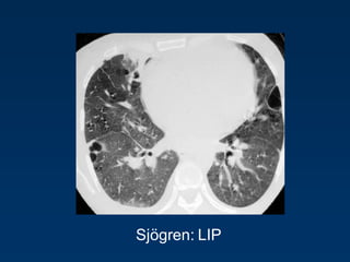 Sjögren: LIP
 