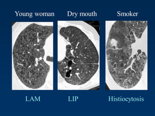 Young woman Dry mouth Smoker
LAM LIP Histiocytosis
 
