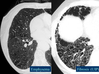 Emphysema Fibrosis (UIP)
 