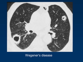Wegener„s disease
 