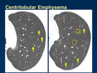 Centrilobular Emphysema
 