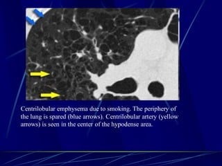 Centrilobular emphysema due to smoking. The periphery of
the lung is spared (blue arrows). Centrilobular artery (yellow
arrows) is seen in the center of the hypodense area.
 