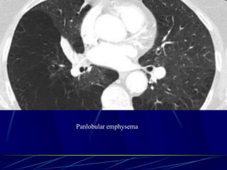 Panlobular emphysema
 
