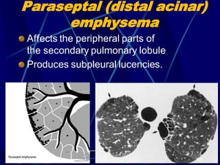 Paraseptal (distal acinar)
emphysema
Affects the peripheral parts of
the secondary pulmonary lobule
Produces subpleural lucencies.
86
 