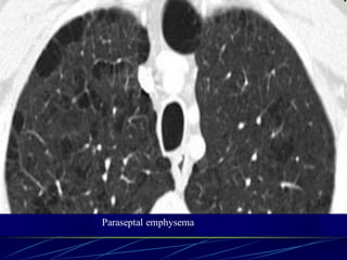 Paraseptal emphysema
 