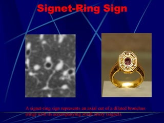 Signet-Ring Sign
A signet-ring sign represents an axial cut of a dilated bronchus
(ring) with its accompanying small artery (signet).
 