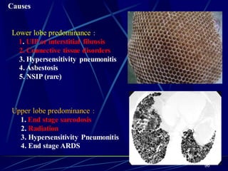 Causes
Lower lobe predominance :
1. UIP or interstitial fibrosis
2. Connective tissue disorders
3. Hypersensitivity pneumonitis
4. Asbestosis
5. NSIP (rare)
Upper lobe predominance :
1. End stage sarcodosis
2. Radiation
3. Hypersensitivity Pneumonitis
4. End stage ARDS
96
 