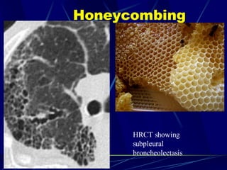 Honeycombing
HRCT showing
subpleural
broncheolectasis
 