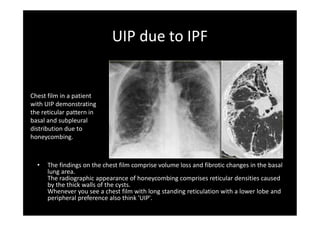 Uip Radiographic Interstitial lung diseases radiology | PDF