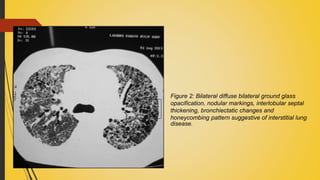 Interstitial lung disease with rheumatological diseases | PPTX