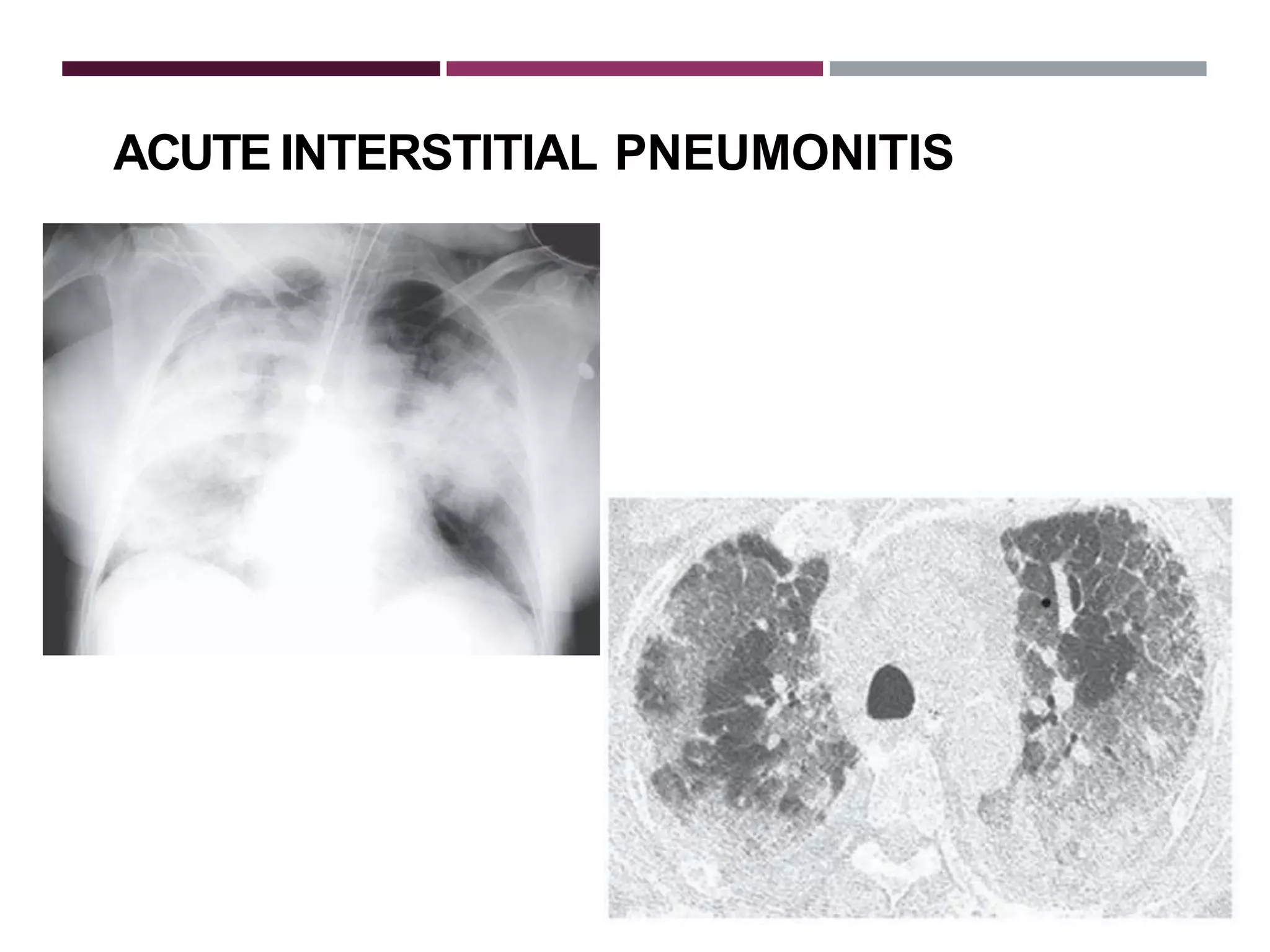 Interstitial Interstitial lung fibrosis diseases | PPTX