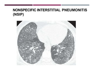 Nsip Classification Interstitial lung fibrosis diseases | PPTX