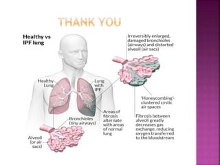 Interstitial pulmonary fibrosis | PPTX