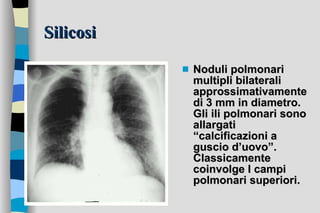 Silicosi Noduli polmonari multipli bilaterali approssimativamente di 3 mm in diametro. Gli ili polmonari sono allargati “calcificazioni a guscio d’uovo”. Classicamente coinvolge I campi polmonari superiori. 
