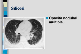Silicosi Opacità nodulari multiple. 
