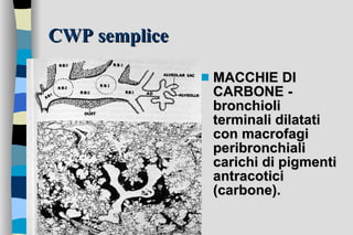 CWP semplice MACCHIE DI CARBONE - bronchioli terminali dilatati con macrofagi peribronchiali carichi di pigmenti antracotici (carbone).   