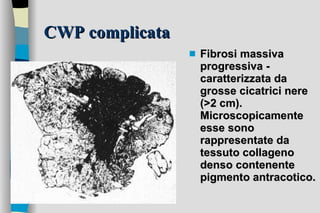CWP complicata Fibrosi massiva progressiva - caratterizzata da grosse cicatrici nere (>2 cm). Microscopicamente esse sono rappresentate da tessuto collageno denso contenente pigmento antracotico.   