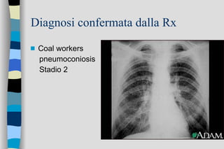 Diagnosi confermata dalla Rx Coal workers pneumoconiosis Stadio 2 