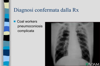Diagnosi confermata dalla Rx Coal workers pneumoconiosis complicata 