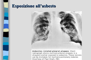 Esposizione all’asbesto 