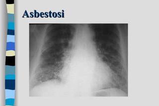 Asbestosi 