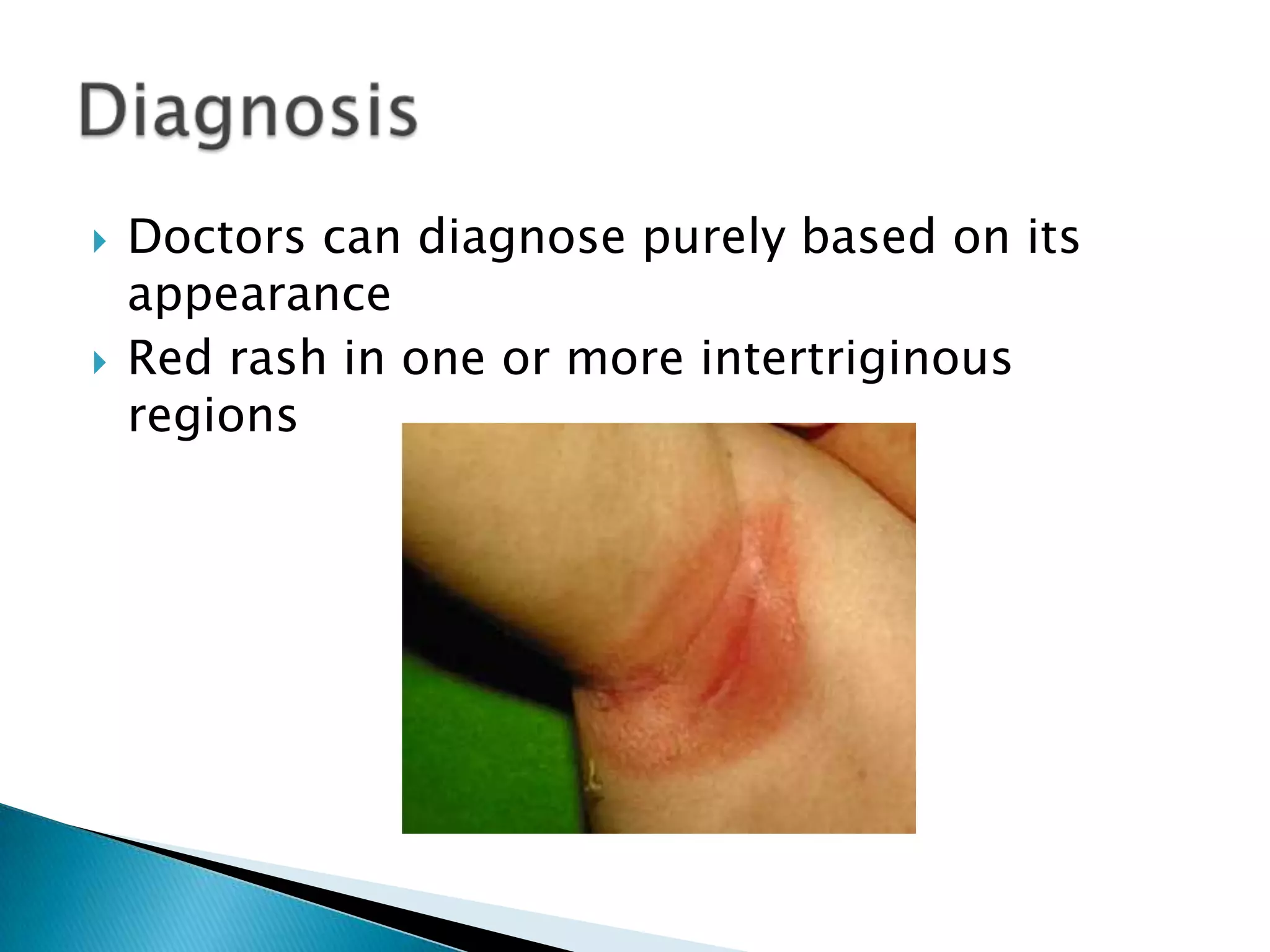 Sweat Rash Intertrigo Intertrigo presentation Joey B | PPTX