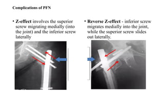 Comprehensive Overview of Intertrochanteric Femur Fractures: Diagnosis ...
