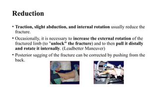 Comprehensive Overview of Intertrochanteric Femur Fractures: Diagnosis ...