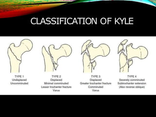 CLASSIFICATION OF KYLE
 