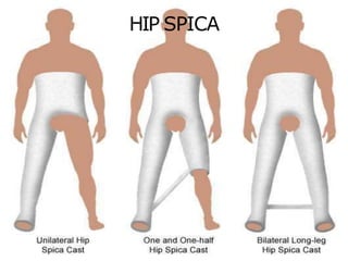 HIP SPICA
 