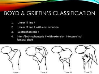 BOYD & GRIFFIN’S CLASSIFICATION 
1. Linear IT line # 
2. Linear IT line # with comminution 
3. Subtrochanteric # 
4. Inter-/Subtrochanteric # with extension into proximal 
femoral shaft 
 