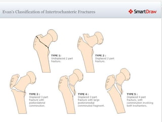 EVAN’S CLASSIFICATION 
 