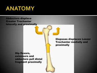 Abductors displace
Greater Trochanter
laterally and proximally
Iliopsoas displaces Lesser
Trochanter medially and
proximally
Hip flexors,
extensors and
adductors pull distal
fragment proximally
 