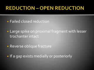 ◾ Failed closed reduction
◾ Large spike on proximal fragment with lesser
trochanter intact
◾ Reverse oblique fracture
◾ If a gap exists medially or posteriorly
 
