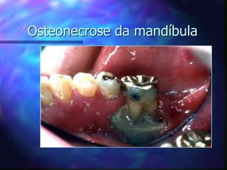 Osteonecrose da mandíbula
 