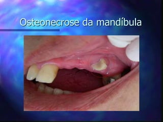 Osteonecrose da mandíbula
 