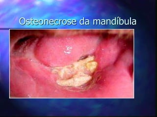 Osteonecrose da mandíbula
 