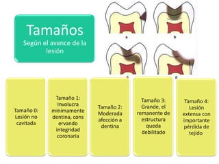 Tamaños
Según el avance de la
lesión

Tamaño 0:
Lesión no
cavitada

Tamaño 1:
Involucra
mínimamente
dentina, cons
ervando
integridad
coronaria

Tamaño 2:
Moderada
afección a
dentina

Tamaño 3:
Grande, el
remanente de
estructura
queda
debilitado

Tamaño 4:
Lesión
extensa con
importante
pérdida de
tejido.

 