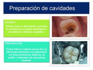 Preparación de cavidades
CAVIDAD:

Brecha, hueco o deformación producida
en el diente por procesos patológicos o
traumáticos o defectos congénitos.

PREPARACIÓN:
Forma interna o externa que se da a un
diente para efectuarle una restauración
con fines preventivos, estéticos, de
sostén, o reemplazo de otras piezas
ausentes.

 