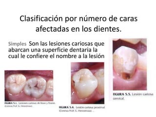 Clasificación por número de caras
afectadas en los dientes.
Simples Son las lesiones cariosas que

abarcan una superficie dentaria la
cual le confiere el nombre a la lesión

 