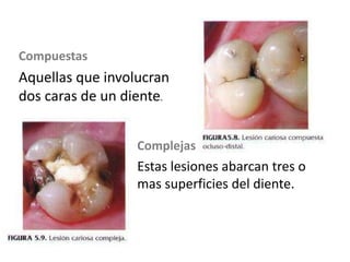 Compuestas

Aquellas que involucran
dos caras de un diente.
Complejas

Estas lesiones abarcan tres o
mas superficies del diente.

 
