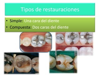 Tipos de restauraciones
• Simple: Una cara del diente
• Compuesta: Dos caras del diente

 