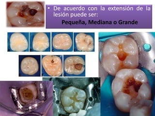 • De acuerdo con la extensión de la
lesión puede ser:
Pequeña, Mediana o Grande

 
