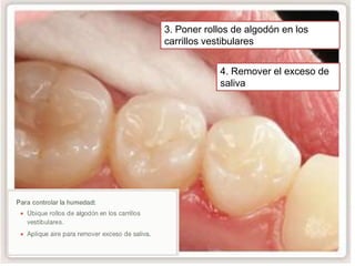 3. Poner rollos de algodón en los
carrillos vestibulares
4. Remover el exceso de
saliva

 