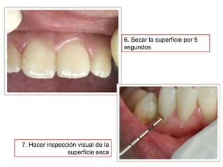 6. Secar la superficie por 5
segundos

7. Hacer inspección visual de la
superficie seca

 