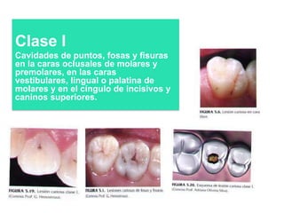 Clase I
Cavidades de puntos, fosas y fisuras
en la caras oclusales de molares y
premolares, en las caras
vestibulares, lingual o palatina de
molares y en el cíngulo de incisivos y
caninos superiores.

 