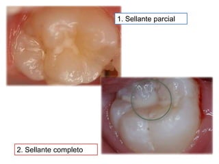 1. Sellante parcial

2. Sellante completo

 