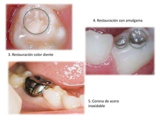 4. Restauración con amalgama

3. Restauración color diente

5. Corona de acero
inoxidable

 