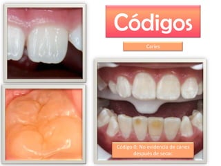 Códigos
Caries

Código 0: No evidencia de caries
después de secar.

 